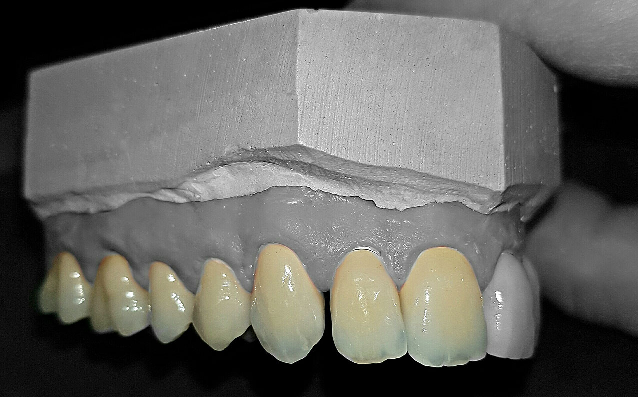 hallweger-dentallabor-zirkon_02